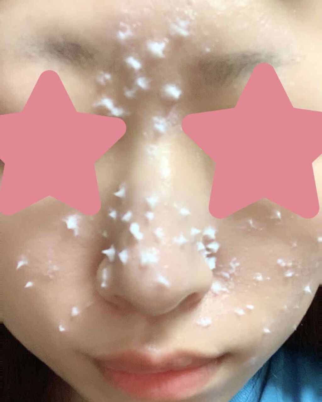 オロナインＨ軟膏 (医薬品)/オロナイン/その他を使ったクチコミ（2枚目）