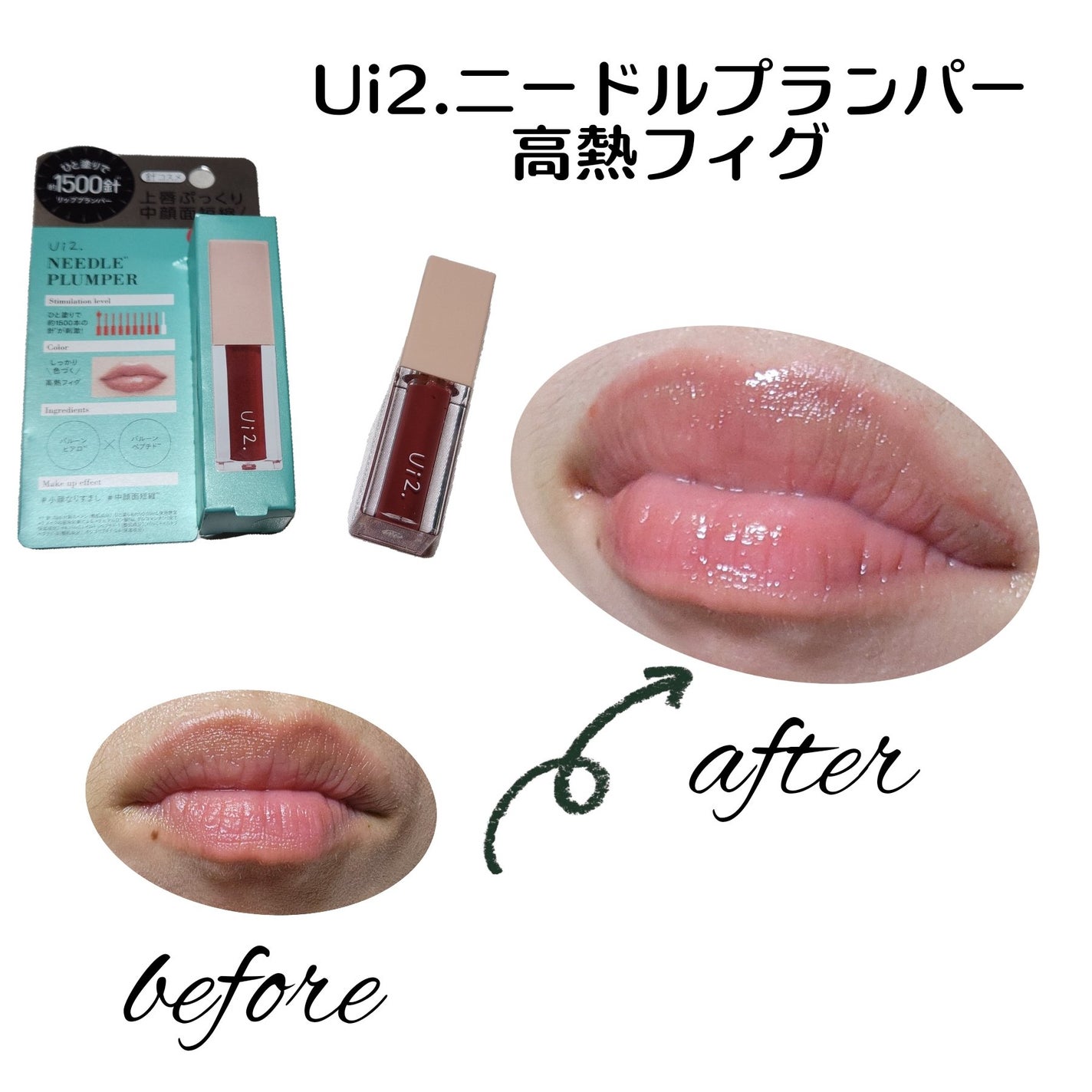 ニードルプランパー 高熱フィグ/Ui2./リッププランパーを使ったクチコミ(3枚目)