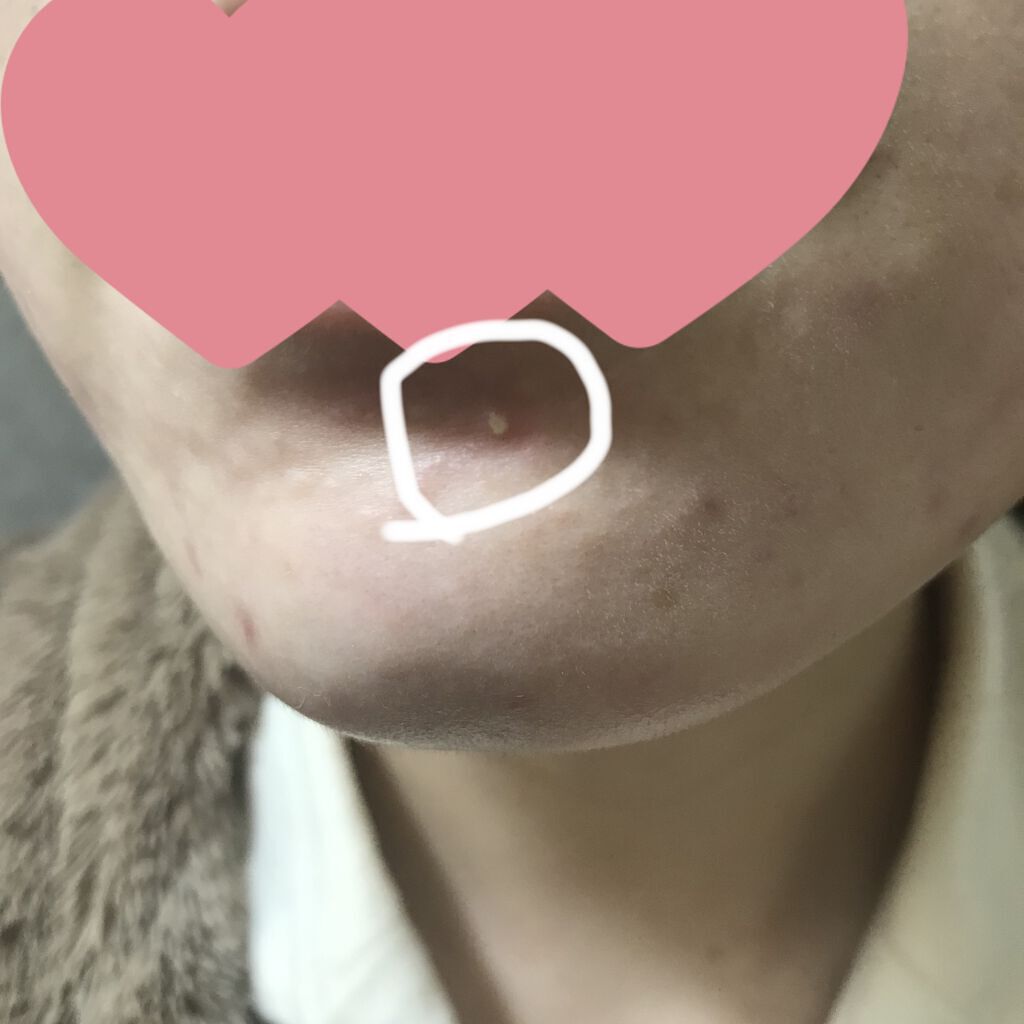 Azelaic Acid Suspension 10%/The Ordinary/美容液を使ったクチコミ（3枚目）