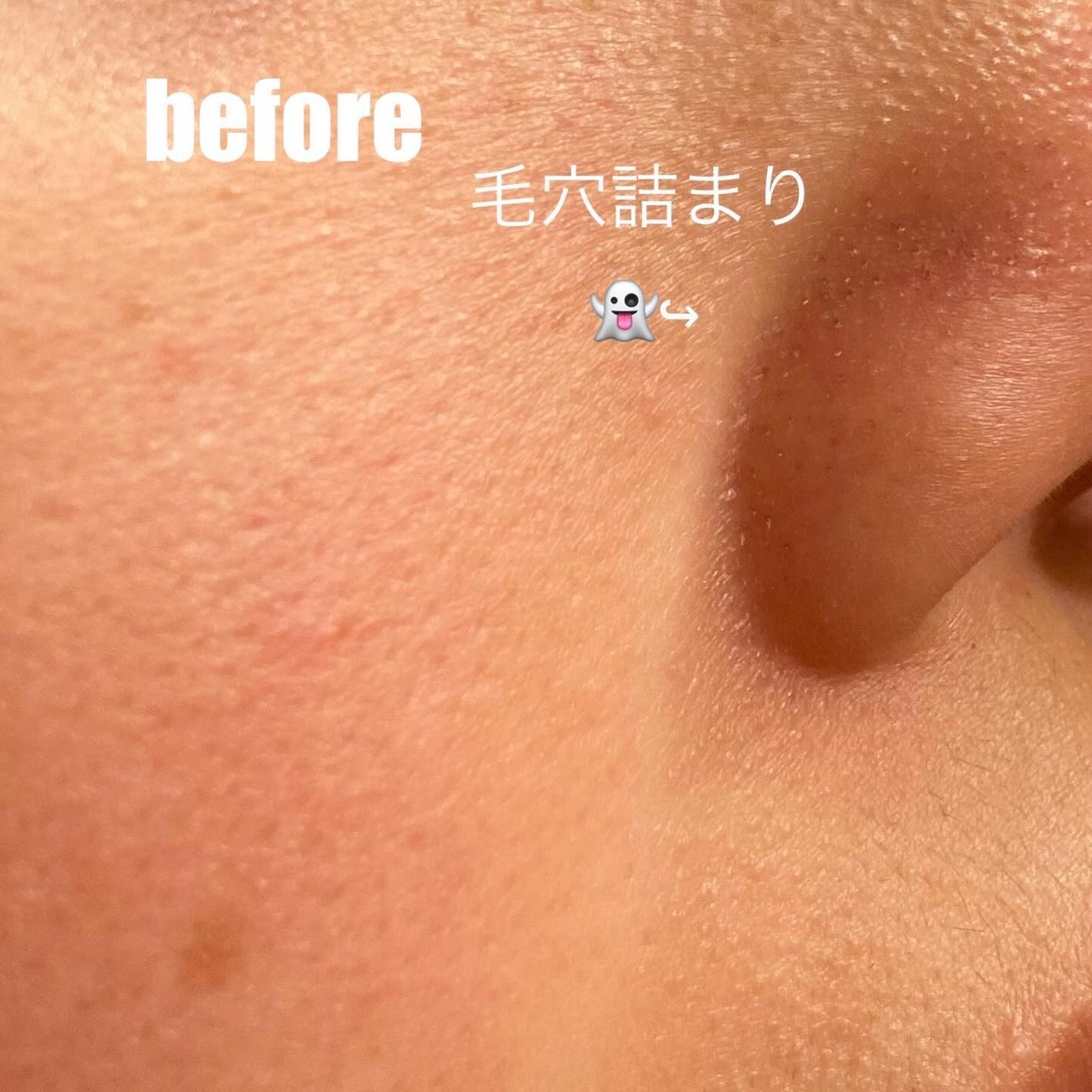 DETクリア ブライト&ピール ピール美容液/Detclear/美容液を使ったクチコミ(2枚目)