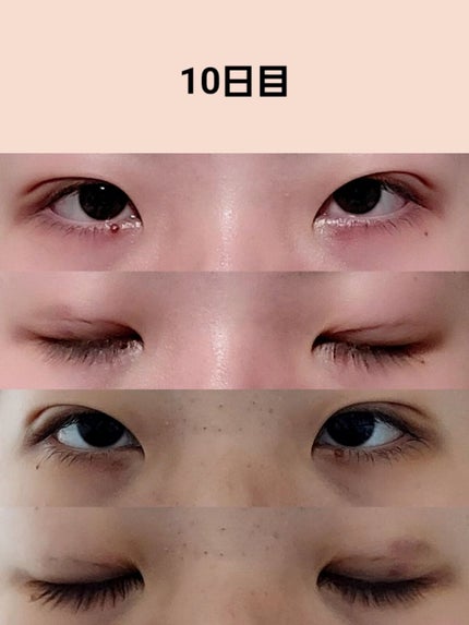 のびーるアイテープ(絆創膏タイプ、レギュラー)/DAISO/二重まぶた用アイテムを使ったクチコミ(6枚目)