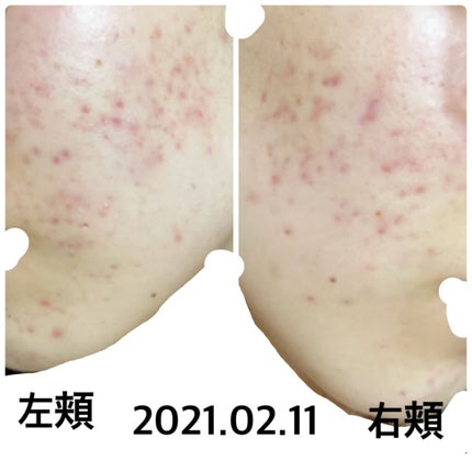 タカミスキンピール/タカミ/ブースター・導入液を使ったクチコミ(1枚目)