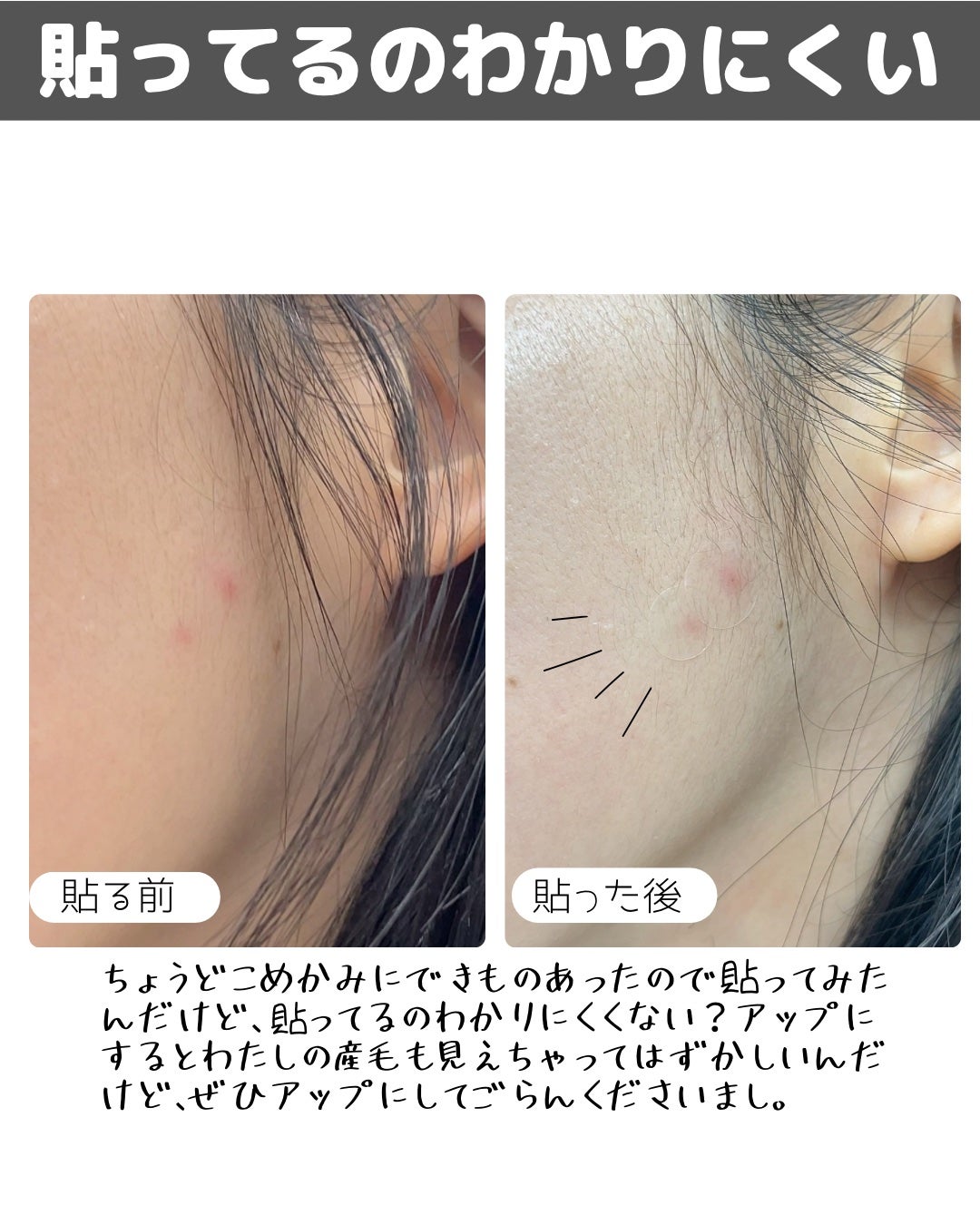 READY CURE PATCH ORIGINAL/マデカダーマ/にきびパッチを使ったクチコミ(5枚目)