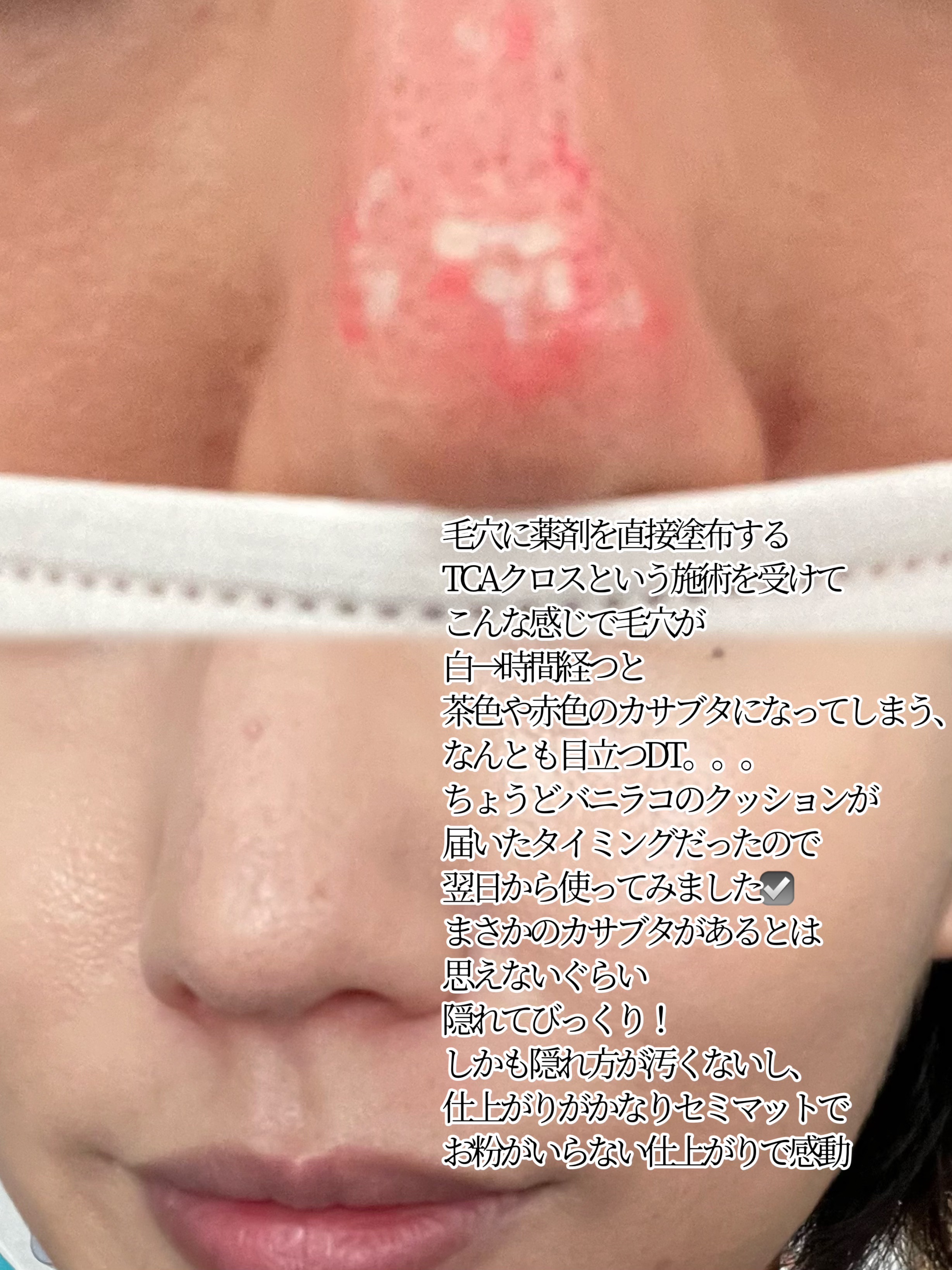 カバーリシャス アルティメット ホワイトクッション 23 ミディアム/BANILA CO/クッションファンデーションを使ったクチコミ（2枚目）