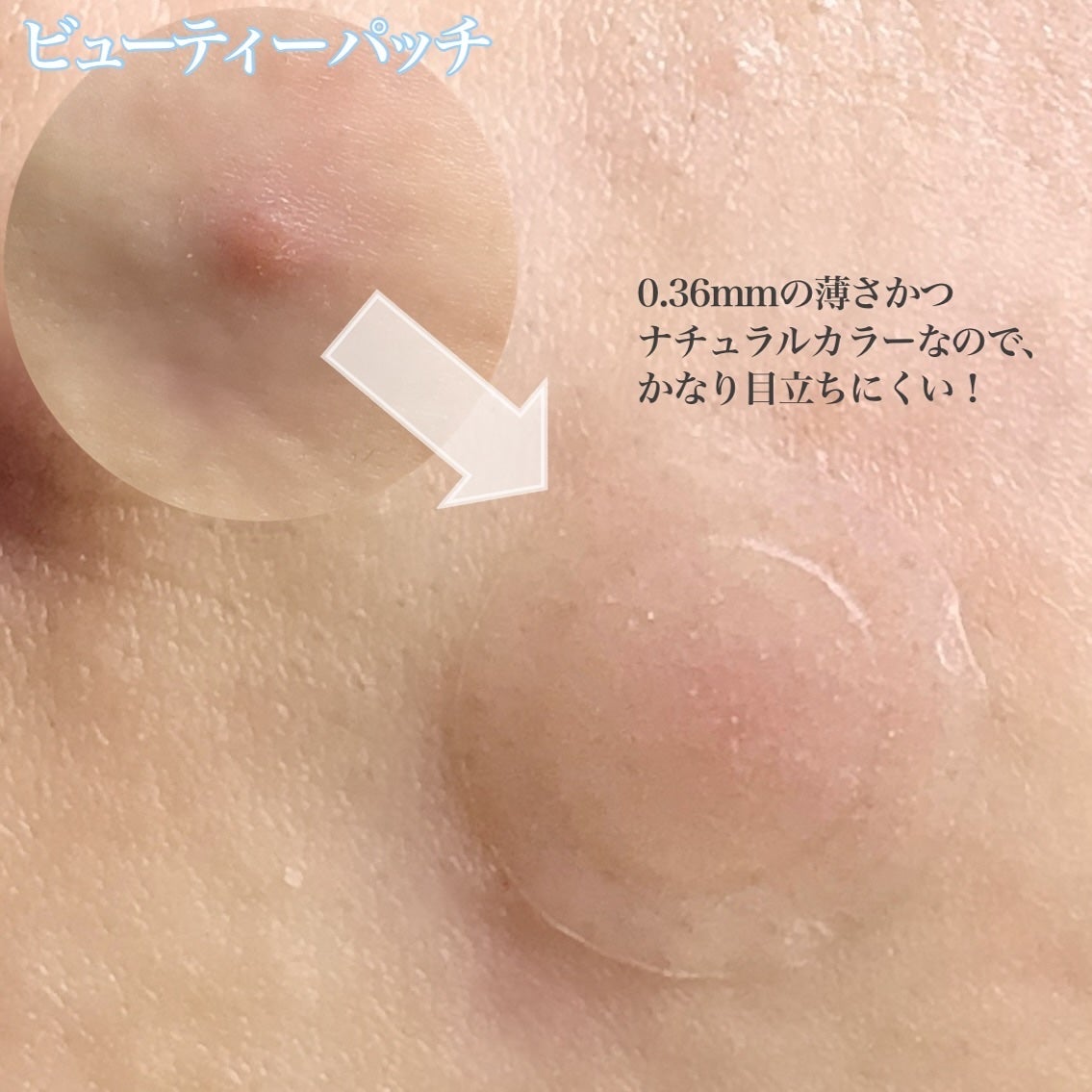ビューティー スポットパッチ/イージーダムビューティー/にきびパッチを使ったクチコミ(3枚目)