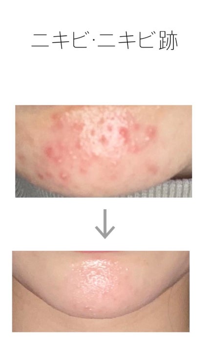 オードムーゲ 薬用ローション(ふきとり化粧水)/オードムーゲ/拭き取り化粧水を使ったクチコミ(1枚目)