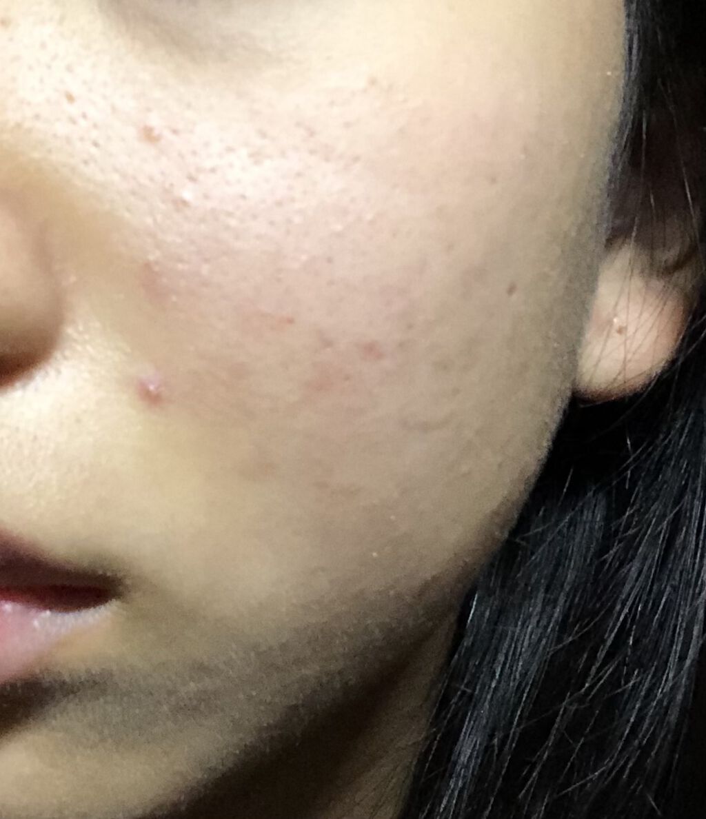 ロゼット洗顔パスタ アクネクリア/ロゼット/洗顔フォームを使ったクチコミ（2枚目）