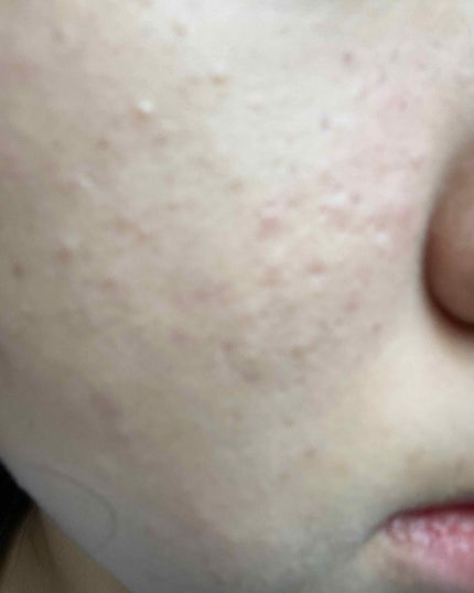 こけし on LIPS 「や肌荒れが酷くて困ってます…色々な化粧水や洗顔を使ってもボロボ..」(1枚目)