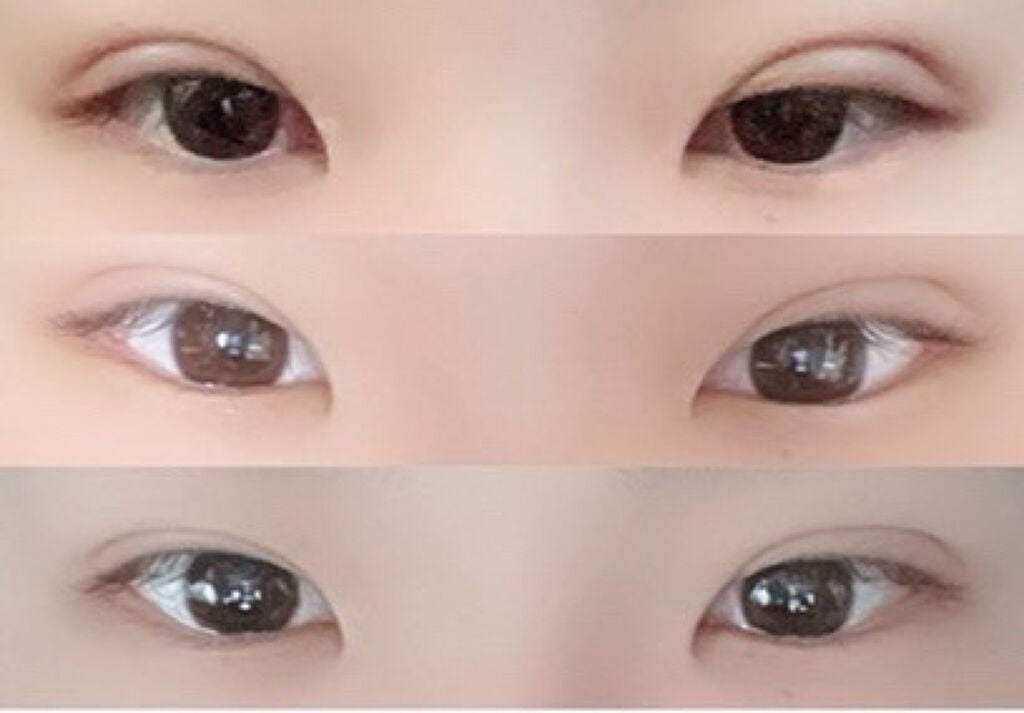 もも on LIPS 「【初投稿】埋没法記録自分用のメモとして投稿します1枚目上施術前..」(2枚目)