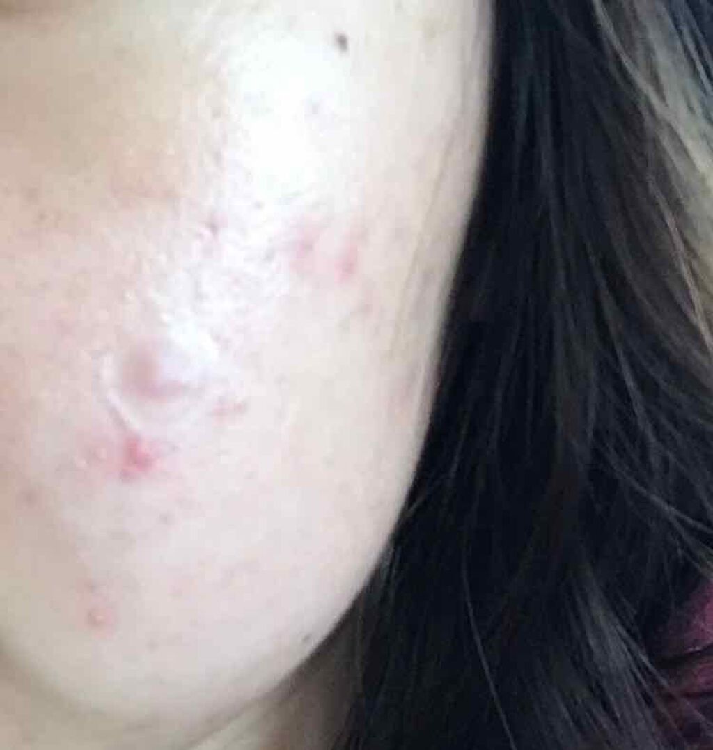 ゼロスポットパッチ/Today’s Cosme/にきびパッチを使ったクチコミ（3枚目）