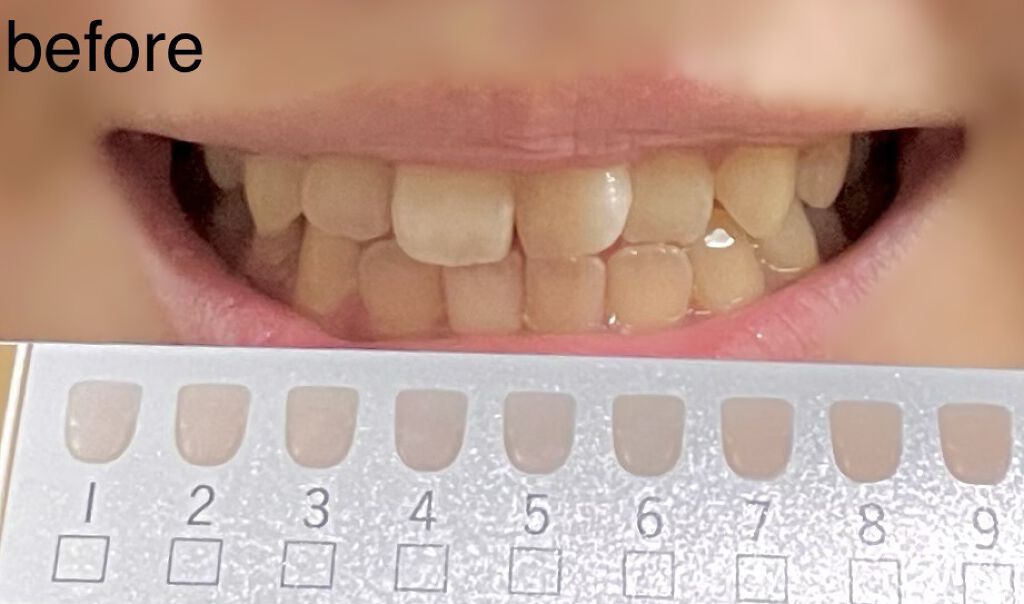 アパガードプレミオ/アパガード/歯磨き粉を使ったクチコミ（2枚目）