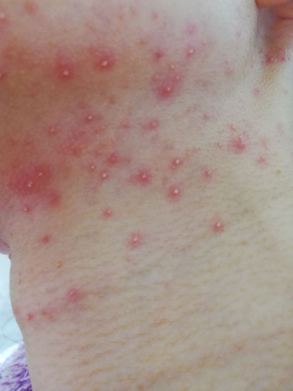 ペアアクネクリームW(医薬品)/ペア/その他を使ったクチコミ（3枚目）