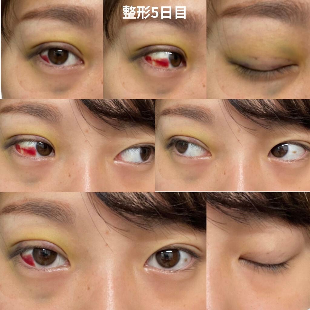 なつ on LIPS 「二重整形(埋没)しました整形記録1閲覧注意2日目〜 右目眼球内..」(6枚目)