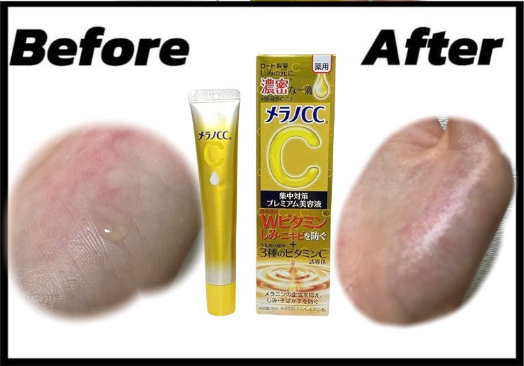 薬用しみ集中対策 プレミアム美容液/メラノCC/美容液を使ったクチコミ(1枚目)