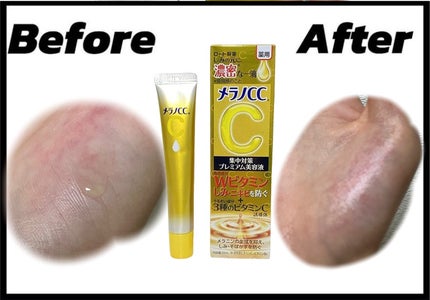 薬用しみ集中対策 プレミアム美容液/メラノCC/美容液を使ったクチコミ(1枚目)