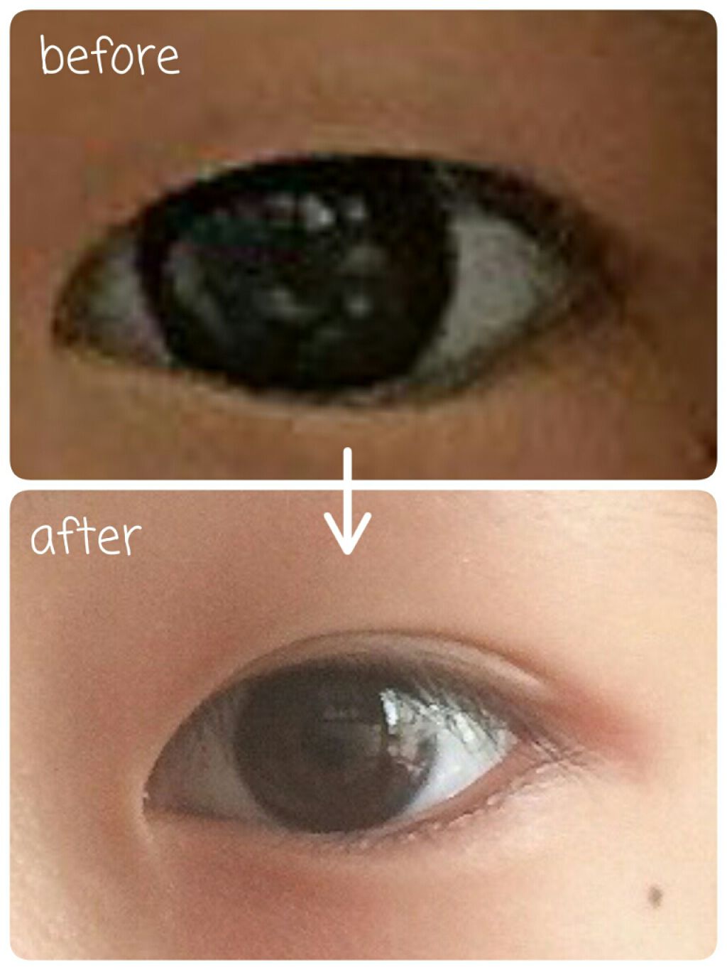 のびーるアイテープ（絆創膏タイプ、レギュラー）/DAISO/二重まぶた用アイテムを使ったクチコミ（2枚目）