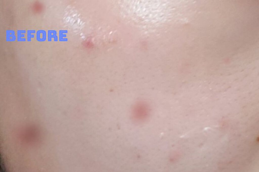 ペアアクネクリームW(医薬品)/ペア/その他を使ったクチコミ（2枚目）