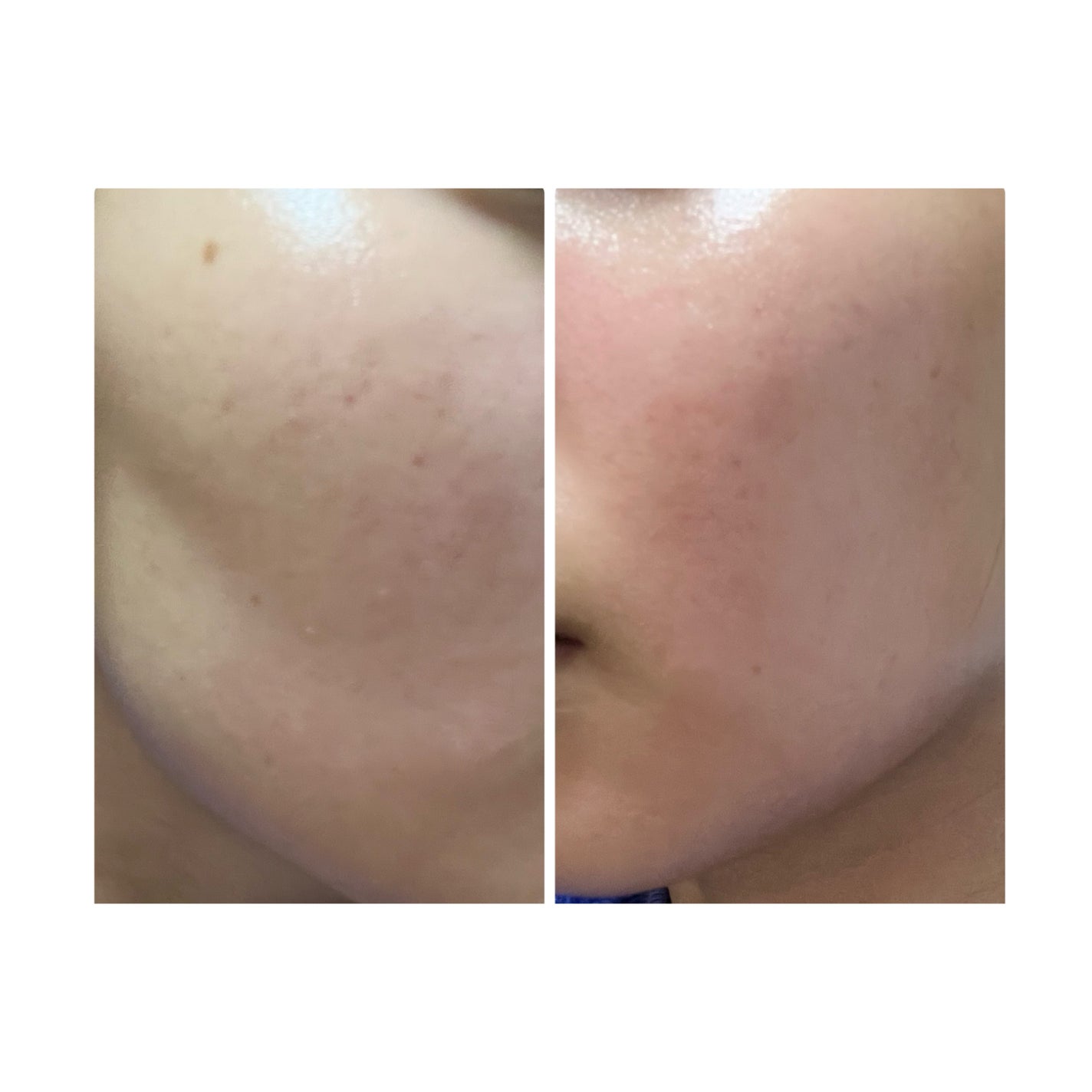 ぽむ on LIPS 「2023.9.13皮膚科に受診 エピデュオとヘパリン処方1枚目..」(5枚目)