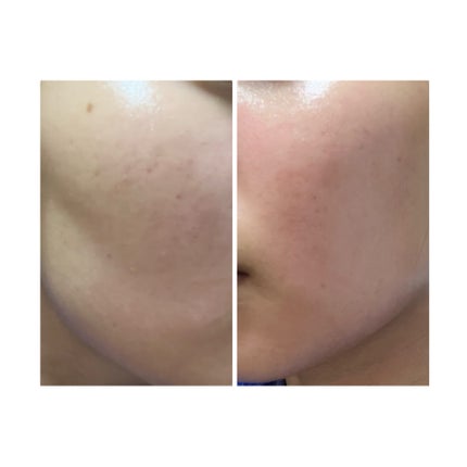 ぽむ on LIPS 「2023.9.13皮膚科に受診 エピデュオとヘパリン処方1枚目..」(5枚目)