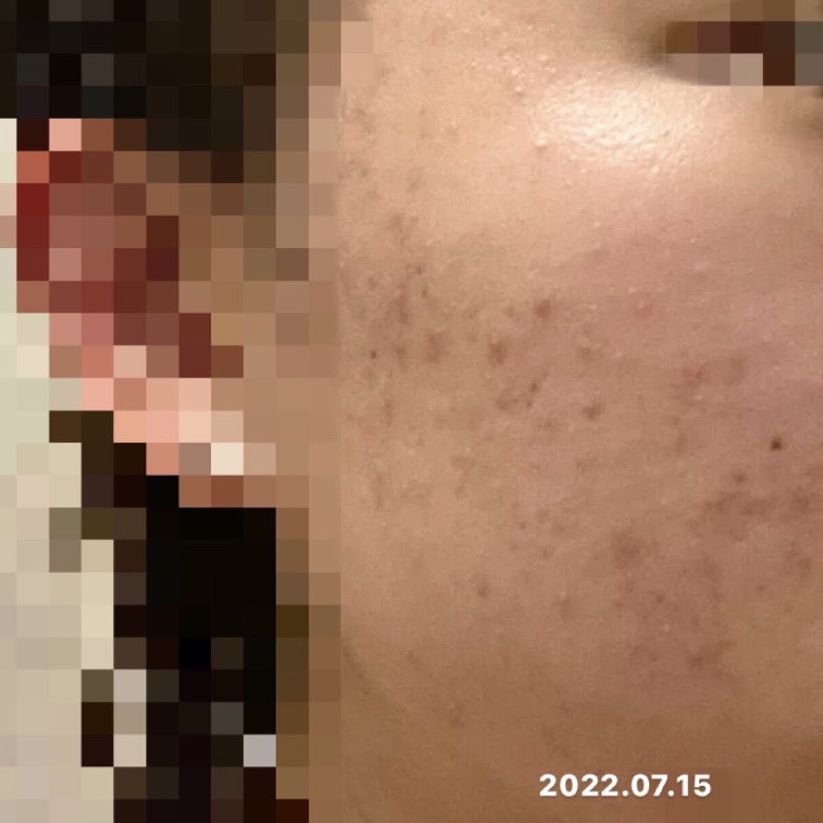 ニキビあとケアジェル/アットノン/その他スキンケアを使ったクチコミ（3枚目）