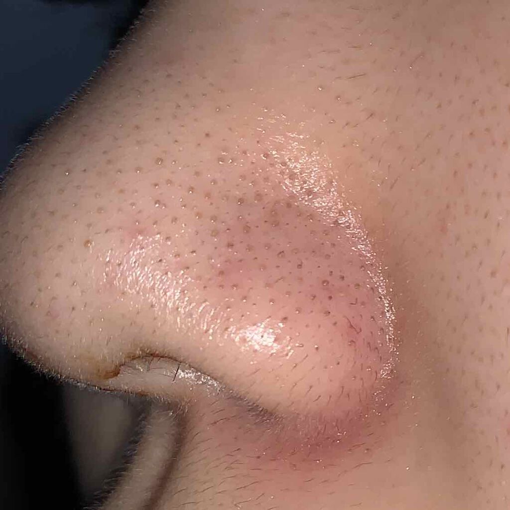 可愛くなりたい子必見🍓 on LIPS 「皆さんこんにちは!いかです!突然ですが皆さん、鼻の毛穴気になり..」(2枚目)