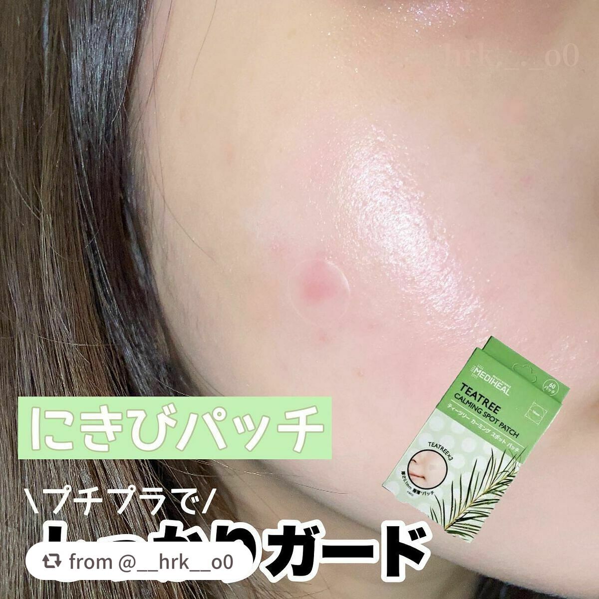 ティーツリーカーミングスポットパッチ/MEDIHEAL/その他スキンケアを使ったクチコミ(1枚目)