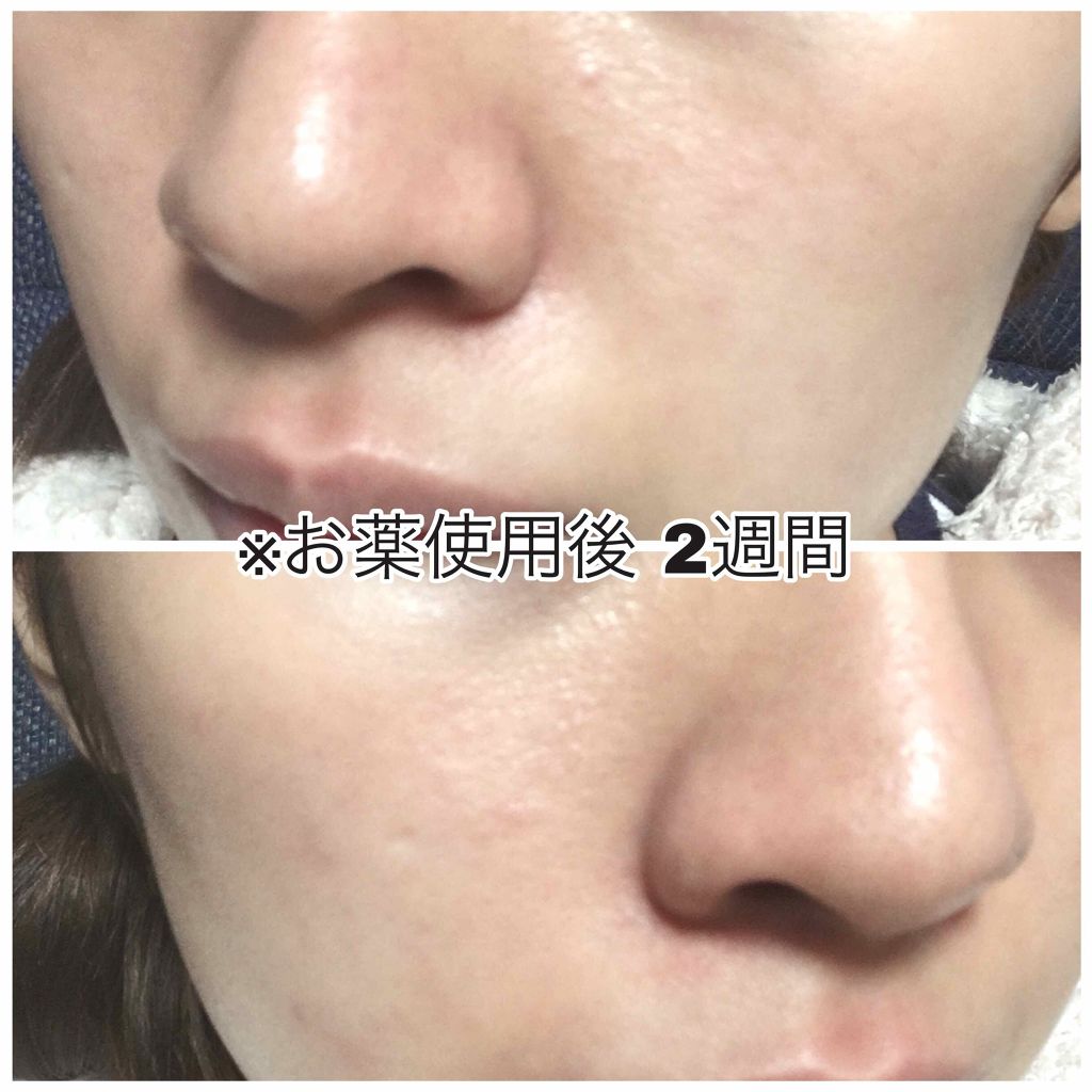 ビーソフテン ローション(医薬品)/持田製薬/その他を使ったクチコミ（3枚目）