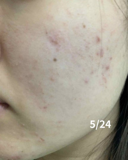 メディカルクリームc(医薬品)/メンソレータム アクネス25/その他を使ったクチコミ(2枚目)