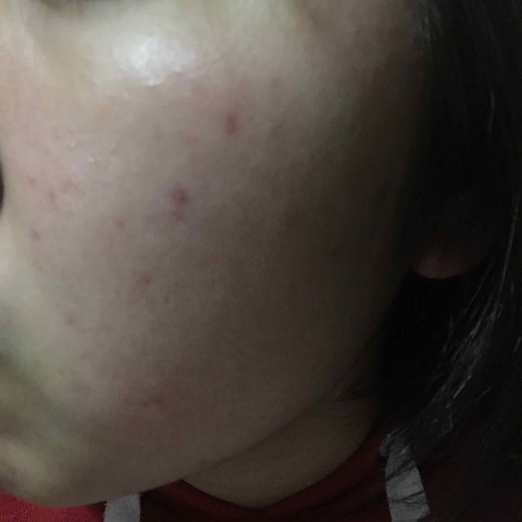 ペアアクネクリームW(医薬品)/ペア/その他を使ったクチコミ（2枚目）