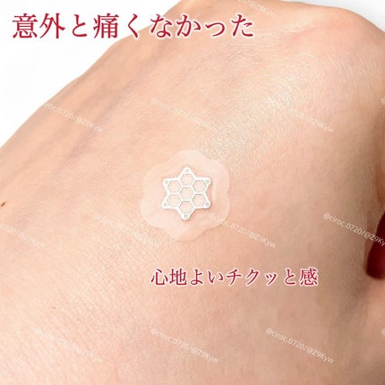 ACマグネシウムパッチ ミニ/スノーツープラス/にきびパッチを使ったクチコミ(5枚目)