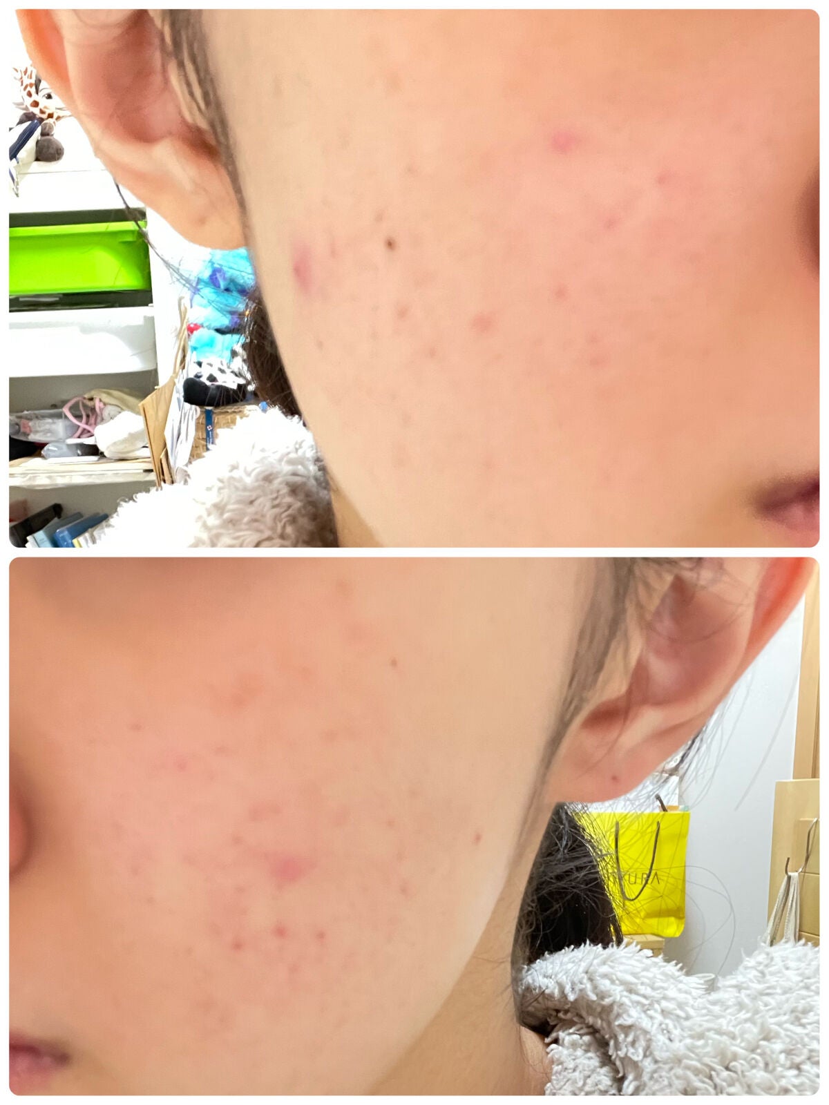 ハムたろくん on LIPS 「肌荒れ日記📖☡✍ニキビできちゃった、、、(;ᯅ;)でっかい..」(2枚目)