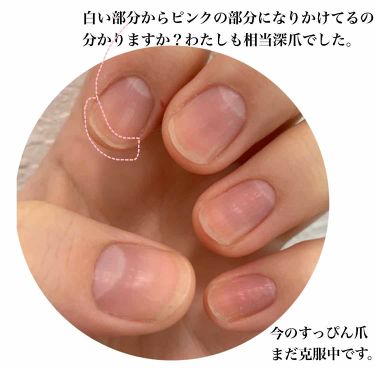 バイター ストップ N マヴァラの口コミ 深爪は絶対治せる 爪噛み癖に悩んでるか By いつか 正直レビュー 混合肌 代後半 Lips