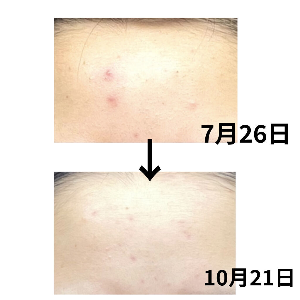 パーフェクトホイップ アクネケア/SENKA（専科）/洗顔フォームを使ったクチコミ（2枚目）