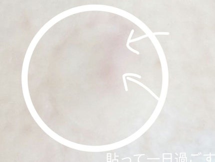 アクネピンプルマスターパッチ /COSRX/にきびパッチを使ったクチコミ(4枚目)