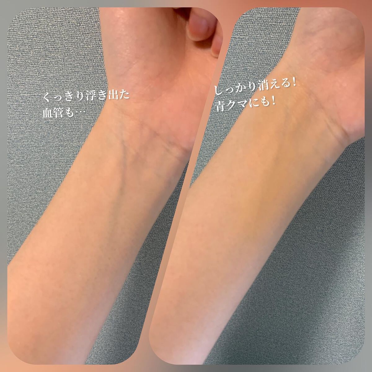 アディクション スキンリフレクト フィックス コンシーラー 004 Light Beige/ADDICTION/リキッドコンシーラーを使ったクチコミ（3枚目）