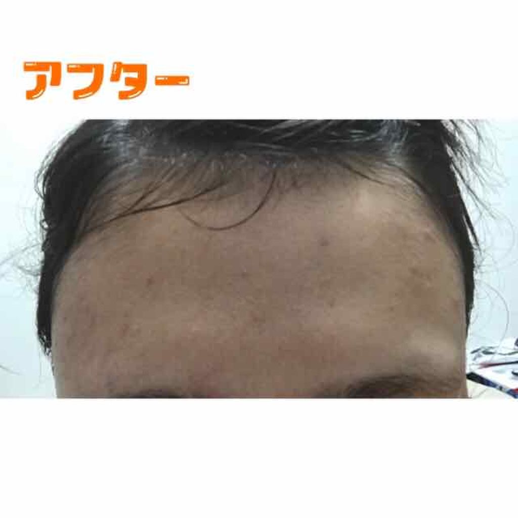 大人のニキビ対策 薬用集中保湿&美白マスク/肌美精/シートマスク・パックを使ったクチコミ(3枚目)