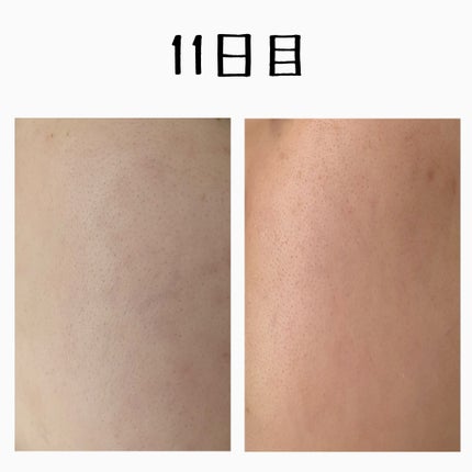 さい on LIPS 「🔥美容医療やってみた🔥//ニキビ跡と長年戦っている者です!つい..」(5枚目)