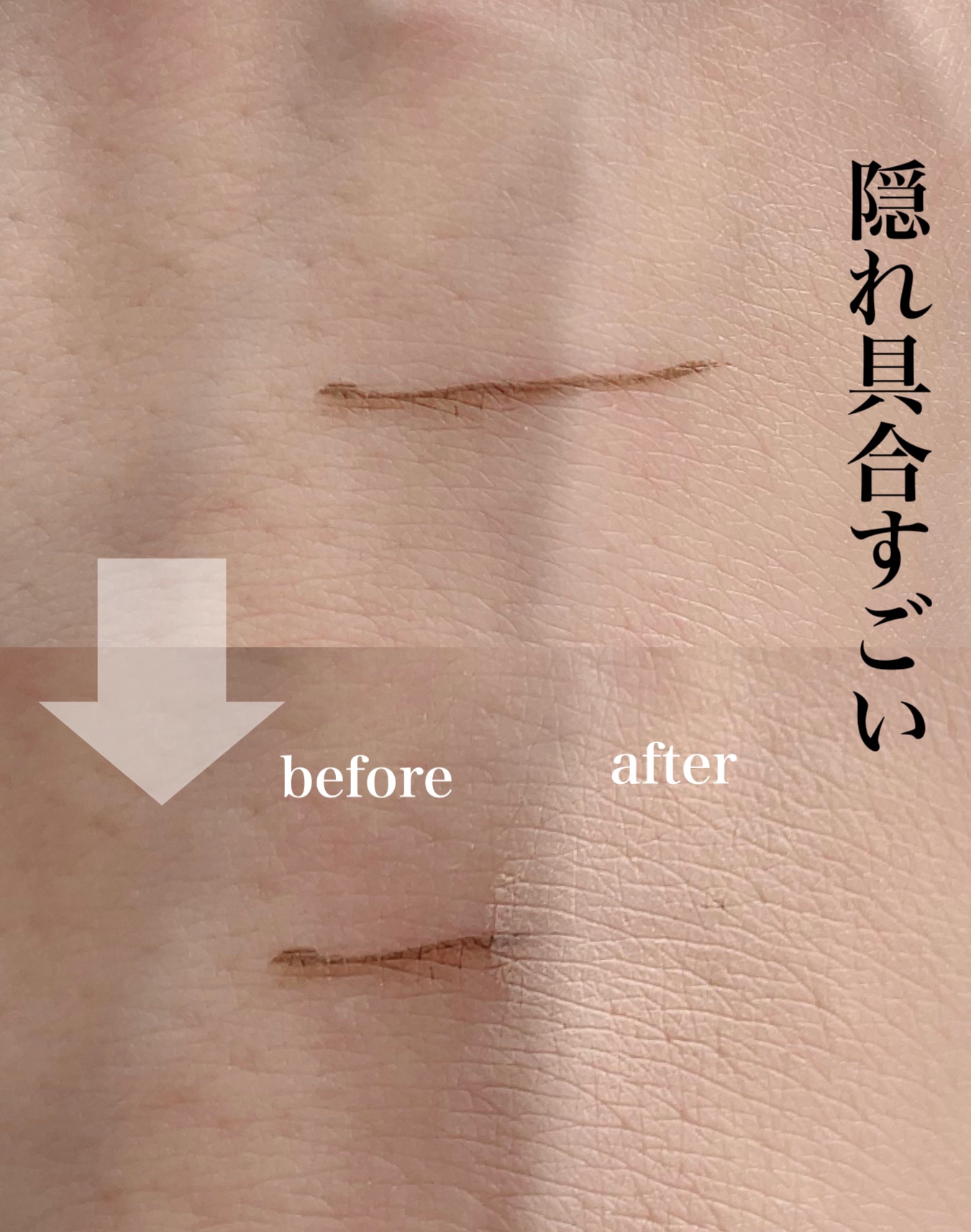 ダーマシンコンシーラー/23years old/リキッドコンシーラーを使ったクチコミ（2枚目）