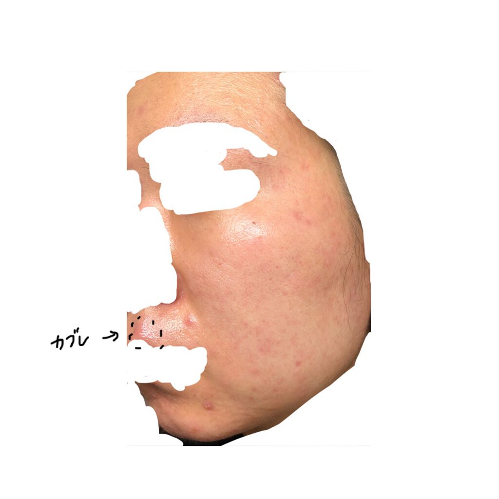 ベジータ on LIPS 「今週の肌 1.23ディフェリンゲル塗っても全然毛穴出てくれなく..」(5枚目)