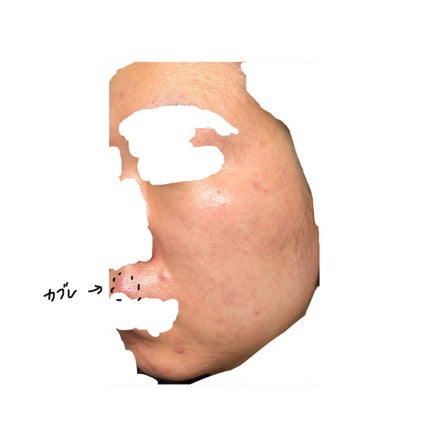 ベジータ on LIPS 「今週の肌 1.23ディフェリンゲル塗っても全然毛穴出てくれなく..」(5枚目)