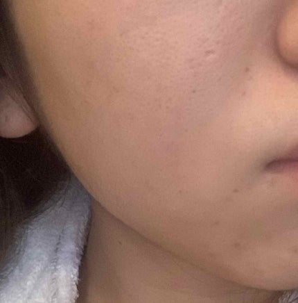 supreme_lips_8sa on LIPS 「私の肌荒れ記録(閲覧注意⚠️)こんにちは。私は小学生の頃からニ..」(4枚目)