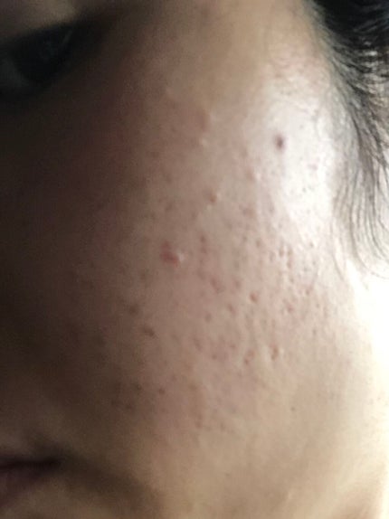 フェイシャルフォーム/ミノン/泡洗顔を使ったクチコミ(2枚目)