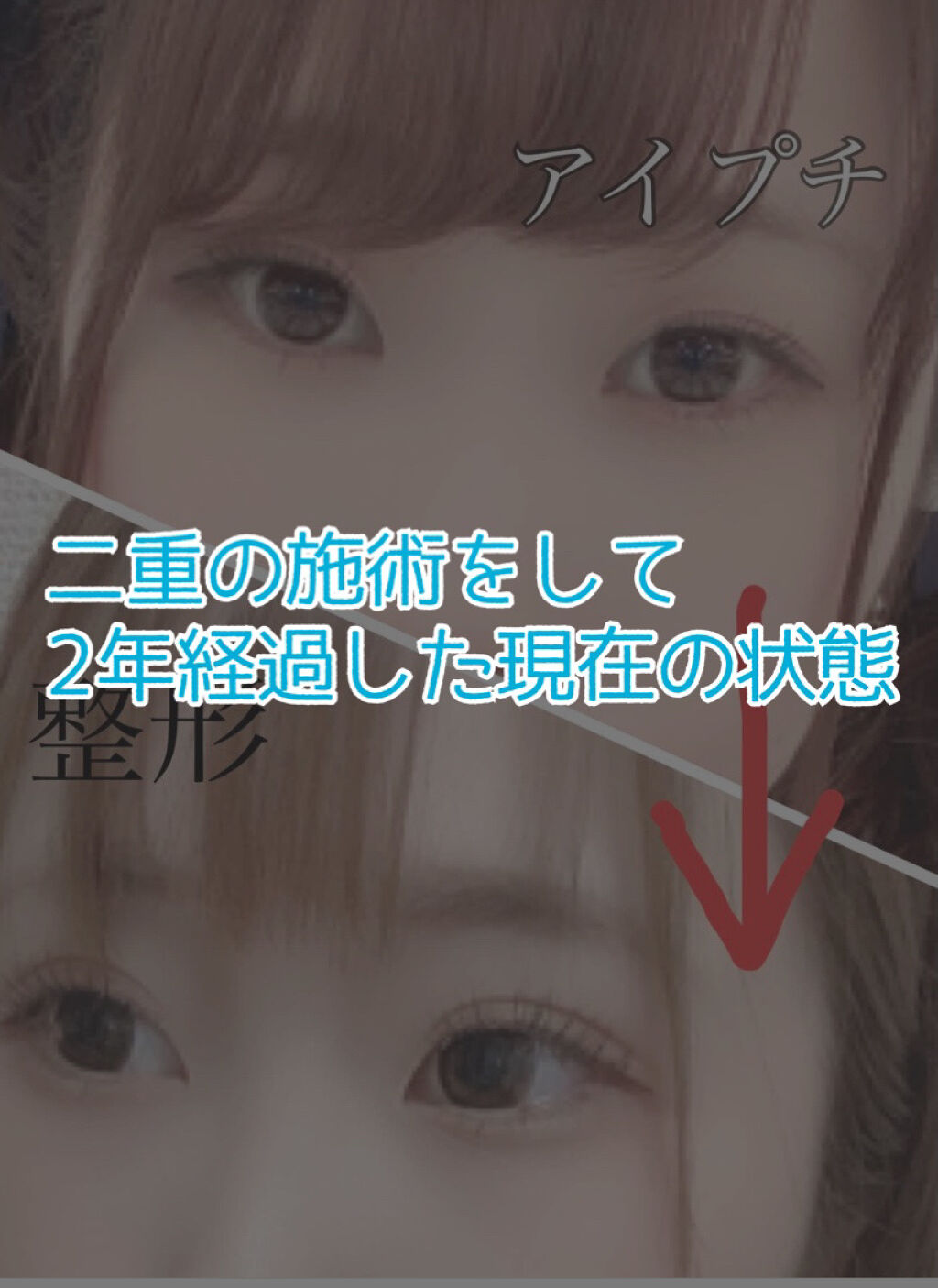 二重整形/その他を使ったクチコミ（1枚目）