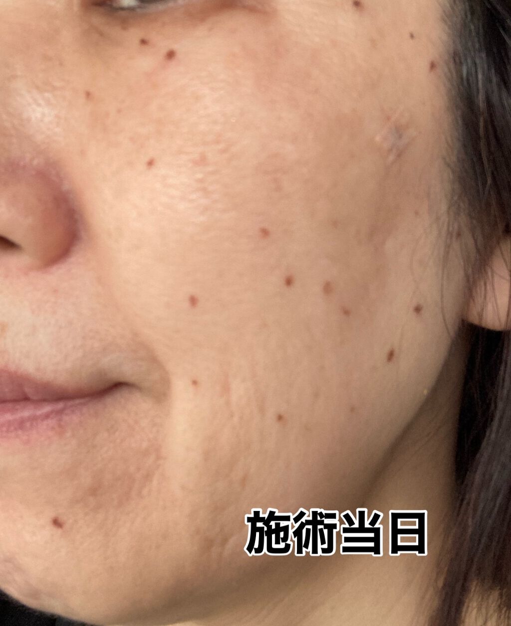 キズを早くきれいに治すパッチ/matsukiyo/その他を使ったクチコミ（3枚目）