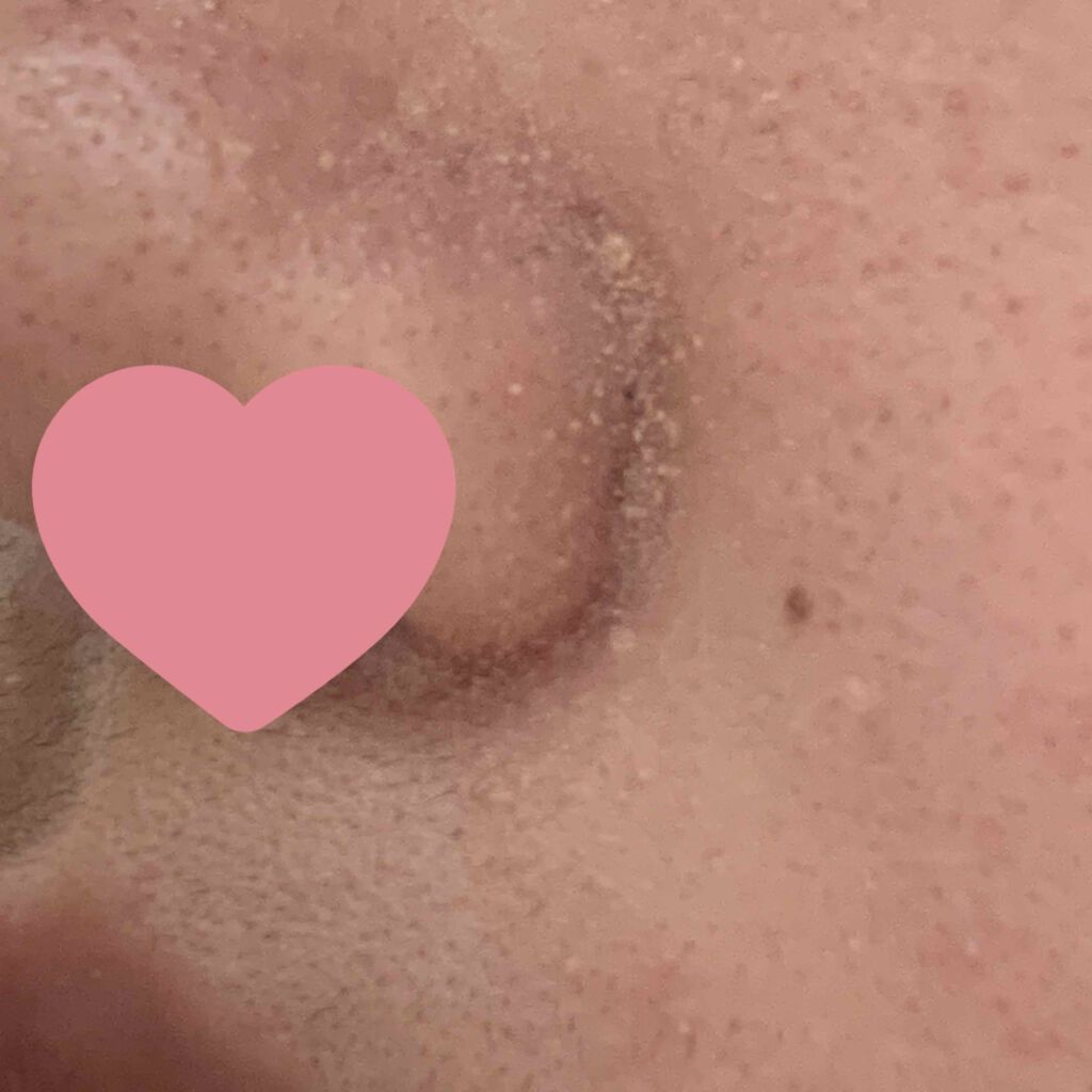 ハトムギ化粧水(ナチュリエ スキンコンディショナー R )/ナチュリエ/化粧水を使ったクチコミ（3枚目）