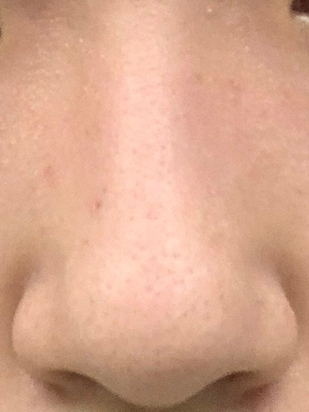 にこ on LIPS 「中学生時代から毛穴、ザラつき、ニキビ、ニキビ跡に悩んできました..」(4枚目)