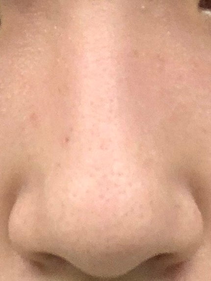 にこ on LIPS 「中学生時代から毛穴、ザラつき、ニキビ、ニキビ跡に悩んできました..」(4枚目)