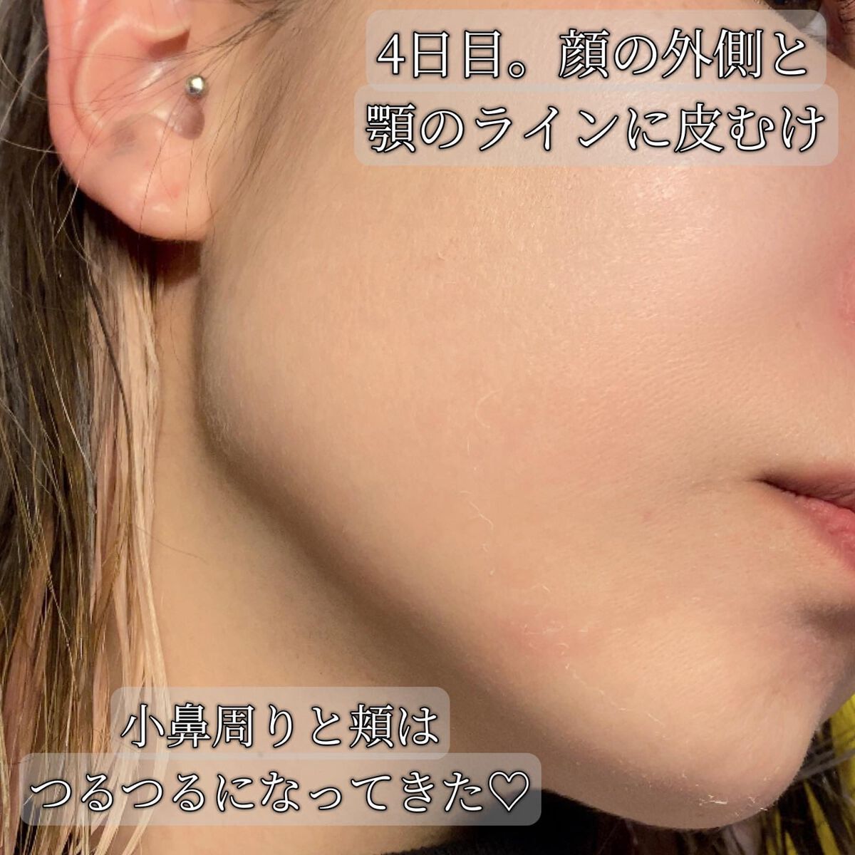 ダーマスキンピーリング/BQCELL/その他キットセットを使ったクチコミ(7枚目)