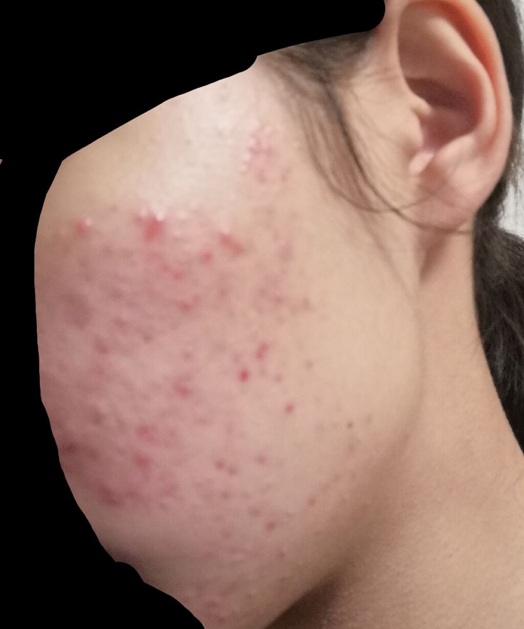 薬用しみ対策 美白化粧水/メラノCC/化粧水を使ったクチコミ（3枚目）