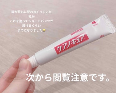 ケアノキュア（医薬品）/小林製薬/その他を使ったクチコミ（1枚目）